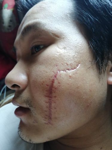 脸部受伤手术后留下10厘米疤,真心想知道像我这样的