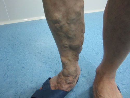 蔓状血管瘤图片