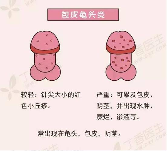3.包皮龟头炎