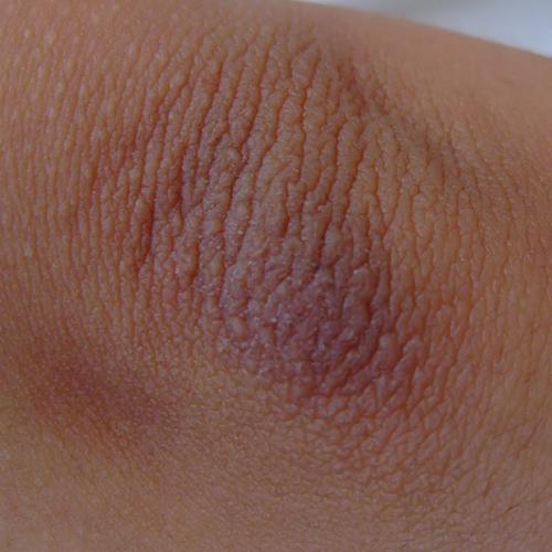 手肘发黑起皮开裂,是什麽毛病?