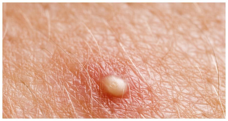 人乳头瘤病毒有很多种,其中有高危型和低危型的,引起尖锐湿疣一般是6