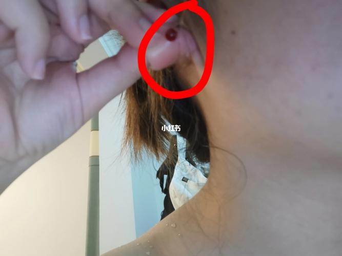 耳洞边有个像血块的脓包,这是发炎了吗?_耳洞_发炎_时尚_时尚其他