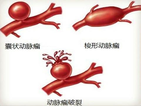 专访王瑞:脑动脉瘤一例分析及基层医生如何科学处置这类患者?