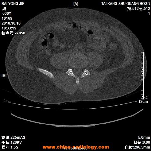 [已会诊] 第1骶椎隐裂?