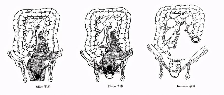 结直肠癌不同手术方式的对比和适应症选择