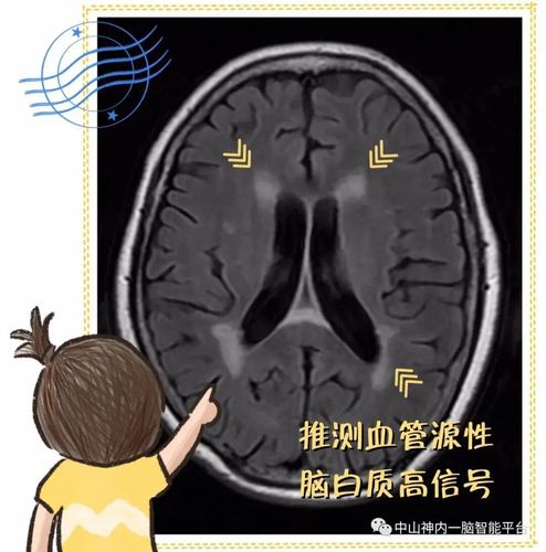 脑缺血灶是脑梗吗