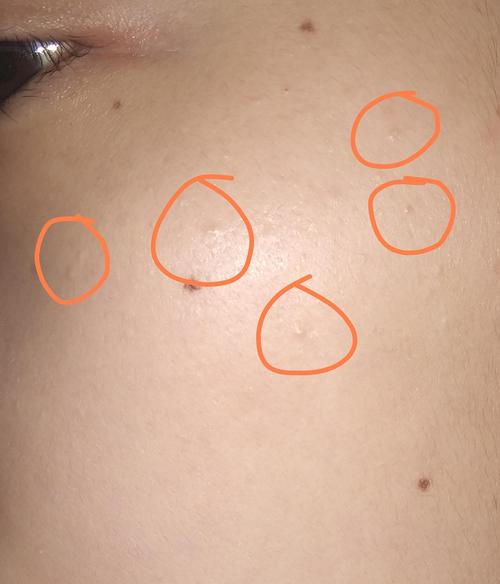 姐妹们知道脸颊两侧这种小疹子是什么吗?好像是栗丘疹