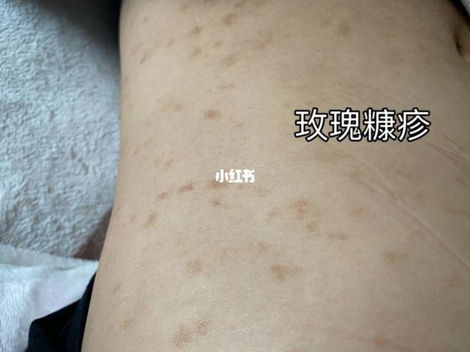 玫瑰糠疹半年了还没好_中药_药膏_鸡腿_玫瑰糠疹_医疗