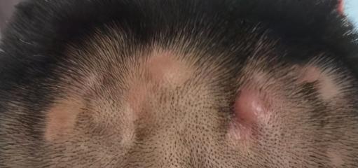 穿掘性毛囊炎治疗后,怎么知道有没有效果?