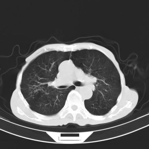 收藏十二个病人的肺ct图像详细解读