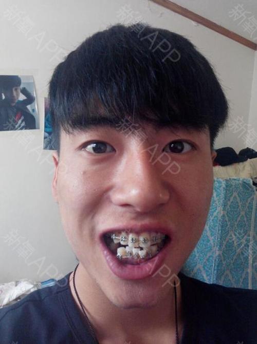 带牙套4个月啦,下面的牙齿排齐咯,准备收缝.