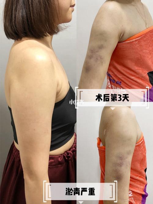 吸脂_运动_新陈代谢_上班族_整形_副乳_手臂环吸_减肥_减肥医药