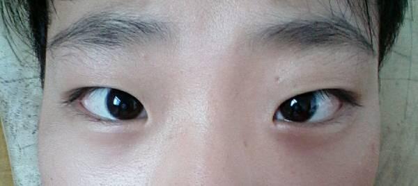 别人都说我是斗鸡眼 这是什么眼 要怎么治