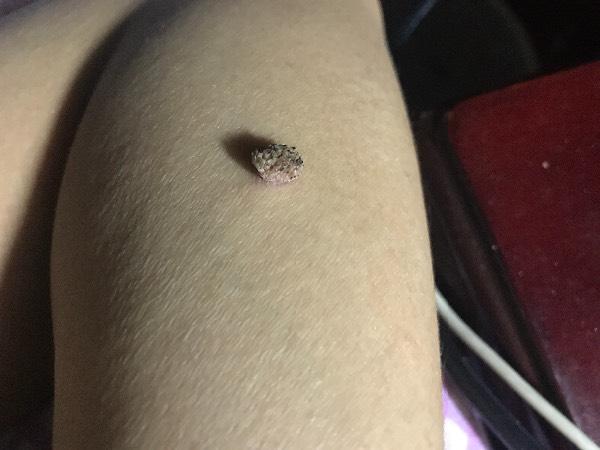 长了一个莲花一样的肉瘤怎么办