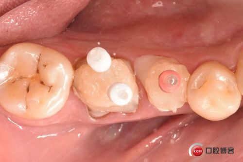 后牙残冠修复之-髓室底修补