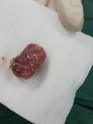 益阳医专附属医院五官科开展等离子切除扁桃体腺样体微创手术