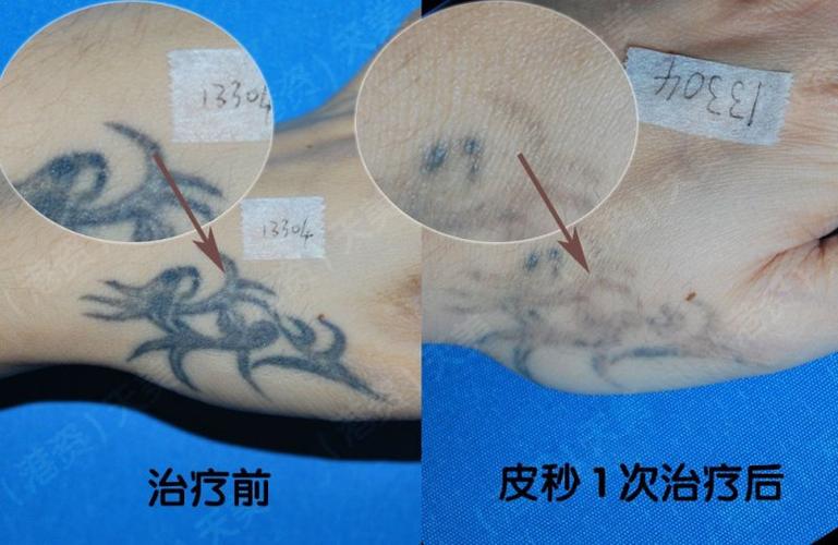 深圳激光洗纹身纹身的终结者皮秒激光洗去纹身恢复洁净美肌