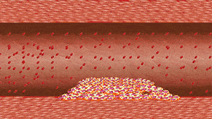 12张动图带你领略血栓形成与转归全过程
