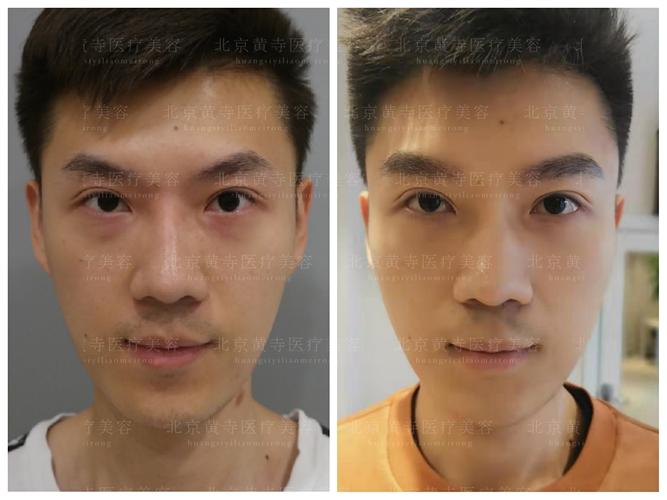 膨体丰眉弓 丰太阳穴 自体脂肪丰额头 隆鼻