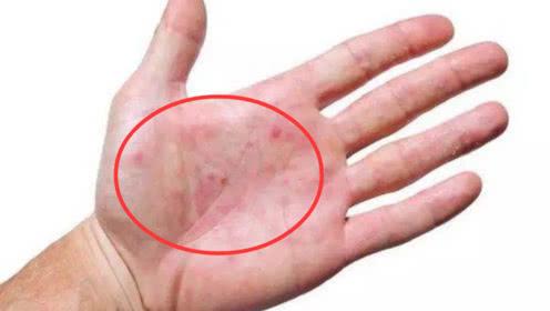 肝癌早期不痛不痒,只要手上出现2个"标记",是肝脏在向你求救