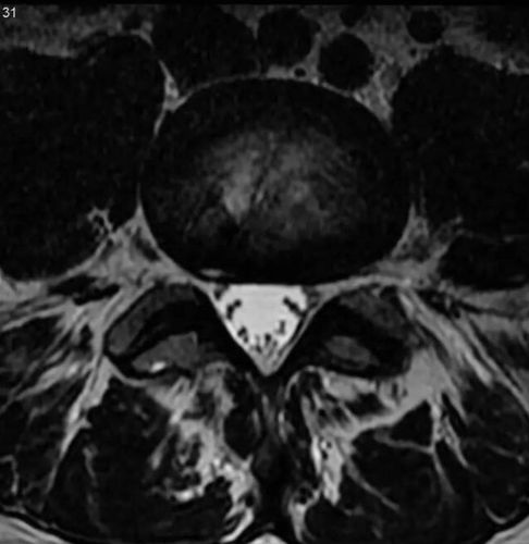 其它 纤维环裂隙(annular fissures) 写美篇 译者:李