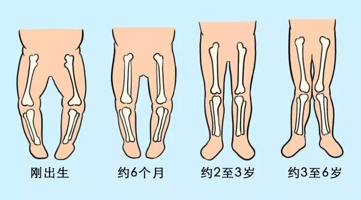 什么是o型腿,x型腿?      宝宝出生小腿就弯