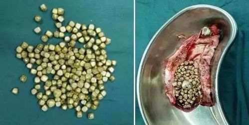 【爱益生】你还在不吃早餐?小心胆结石找上你!