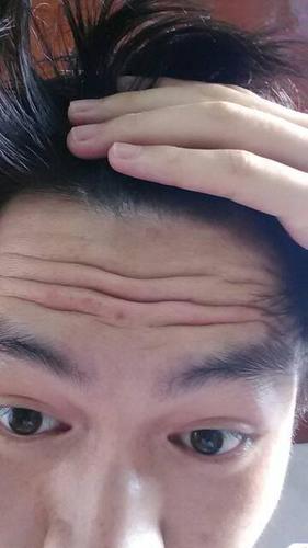 本人男生只要一笑就会有抬头纹和鱼尾纹,皮肤爱出油,是不是出油导致的