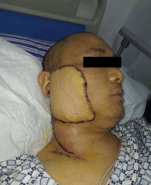 腮腺癌术后修复