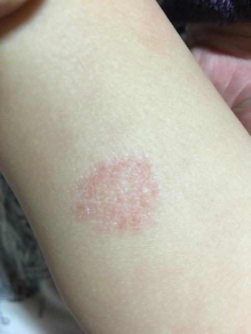 宝宝小腿上长圆藓