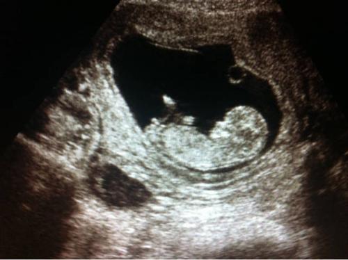 悄悄告诉你,如何从黑白彩超看胎儿性别,医生不说