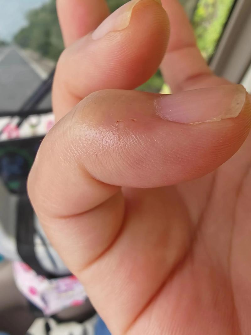 大早上被仓鼠咬了一口,跑了两个医院,都说不用打狂犬疫苗和破伤