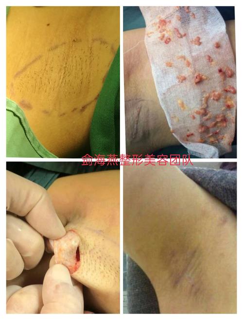 小切口手术图解