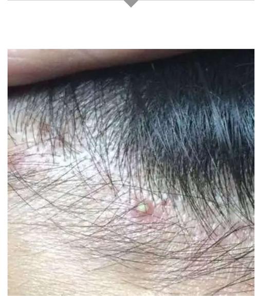 【科普】头皮老长疙瘩和脓包,是什么原因导致的?