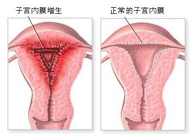 "四维立体综合" 治疗子宫内膜炎克星