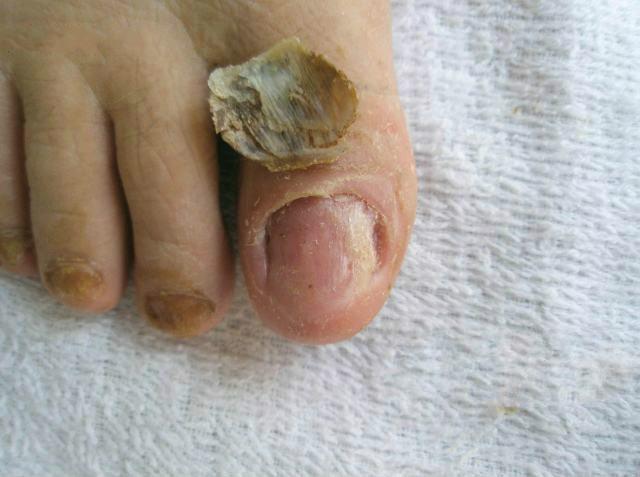 什么是灰指甲