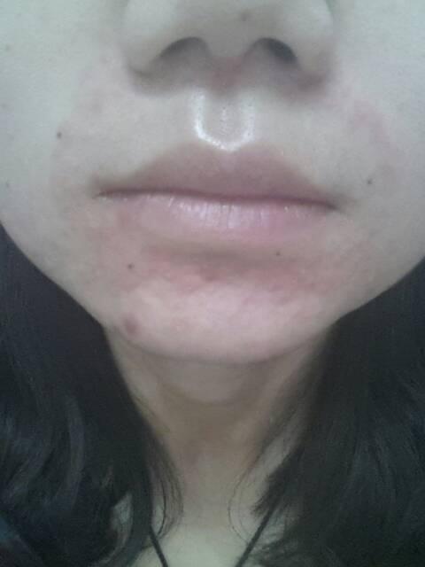 围绕着唇周长了好多粉刺一样的东西,红红的,还特别痒,感觉肿起来了,是