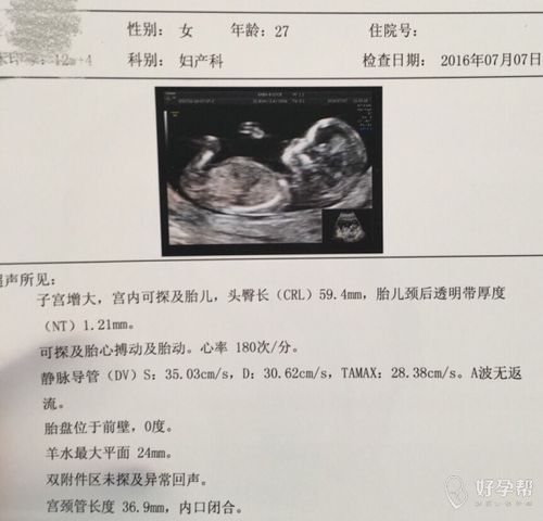 12周做nt心率180是不是有点快,宝妈们能看出男孩女孩吗?