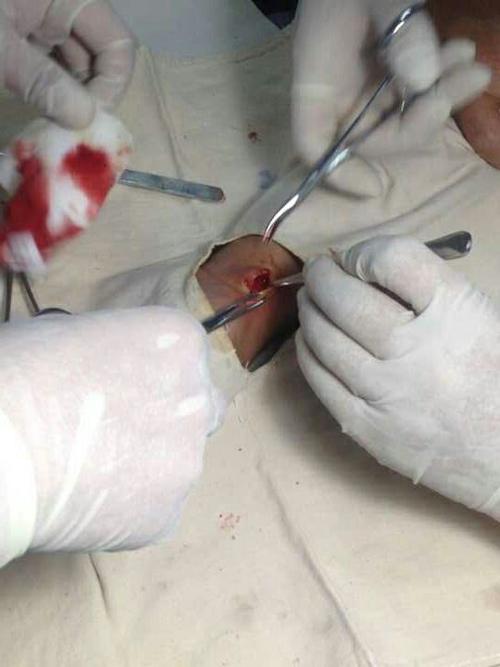 腕部腱鞘囊肿手术全过程