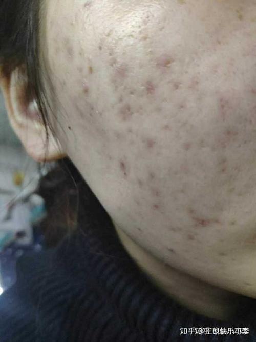 如何去黑色痘印?长了6年了?