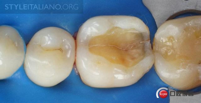 【转载国外病例】隐裂牙预备用渐进切割基质