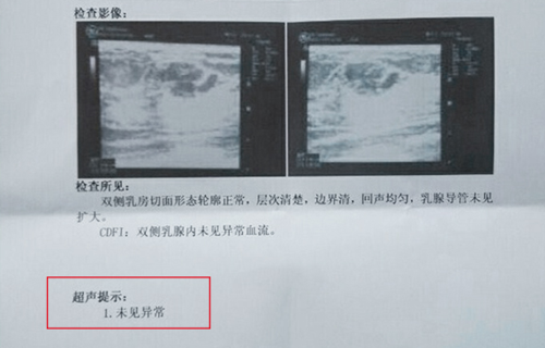 双侧乳腺多发囊性结节怎么办 得了乳腺结节能好吗