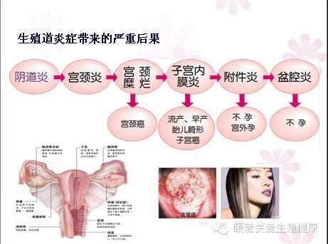 从阴道炎到宫颈癌的过程 - 高山予鹰 - 保健养生