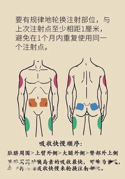 长沙嗲嗲腹痛高热,原是注射胰岛素方法出了错_部位