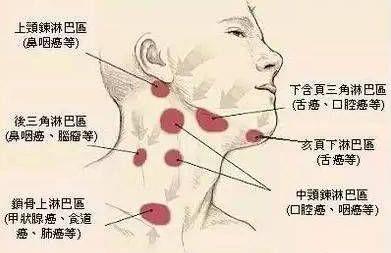 颈淋巴结结核( tuberculous cervical lymphadenitis)多见于儿童和