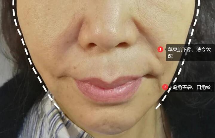 45岁及以上口角囊袋的出现让面部尽显老态
