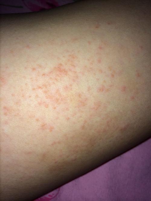 拍张照片好给建议 追问: 追答: 可能是荨麻疹或过敏性皮炎,明天如果没