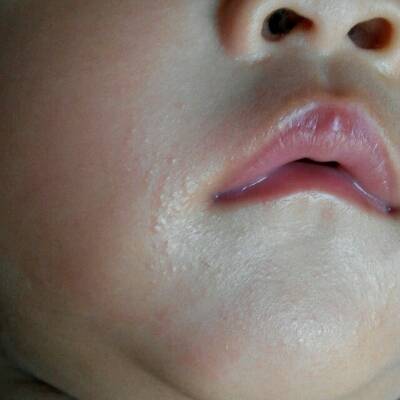 宝宝嘴唇旁边和下巴长的是什么?有宝妈知道吗