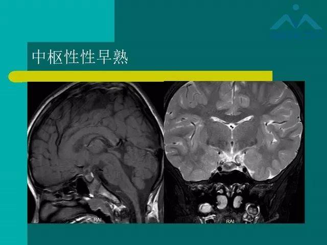 儿童rathke裂囊肿的影像与临床 | 影像天地