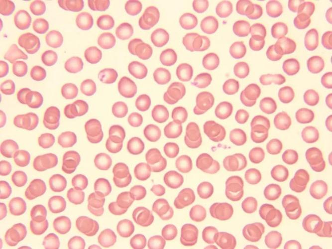 形态学报告中血小板应该如何描述|经验分享